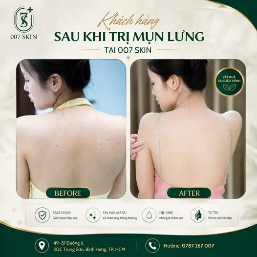 KHÁCH HÀNG SAU KHI TRỊ MỤN LƯNG TẠI 007 SKIN ✨