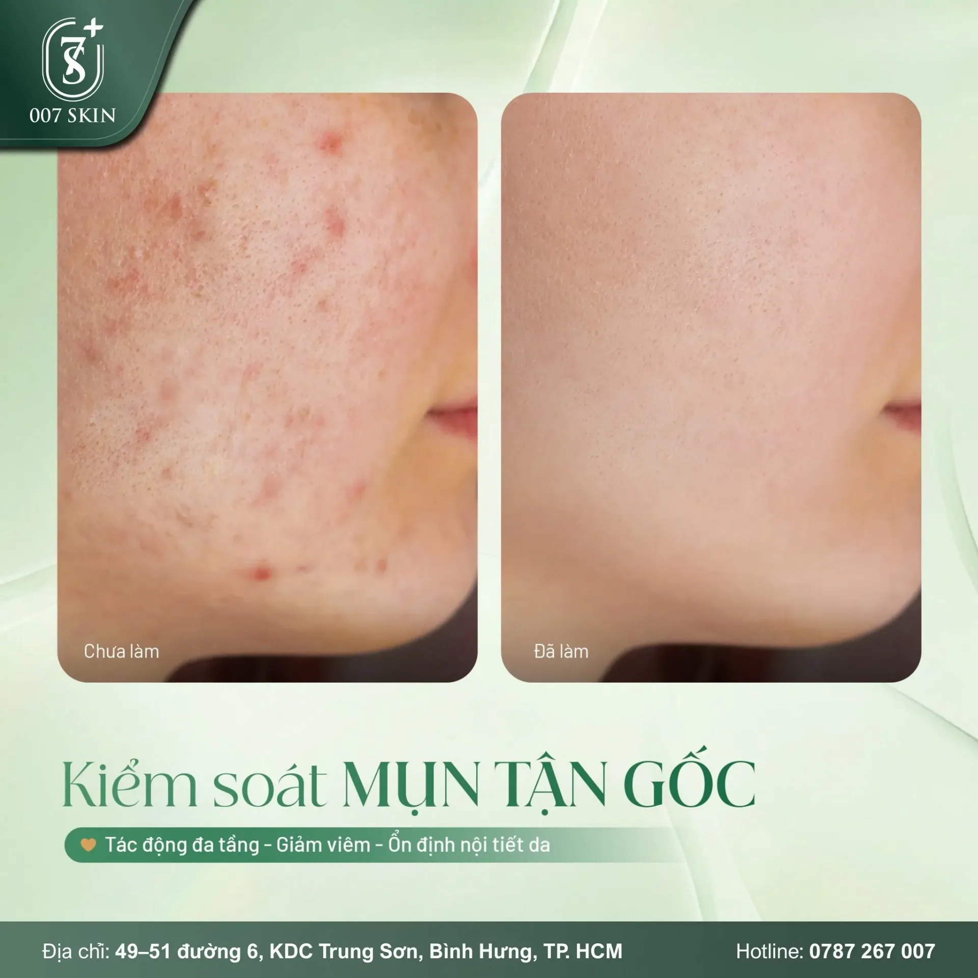 KIỂM SOÁT MỤN TẬN GỐC – DA MỊN THẤY RÕ SAU LIỆU TRÌNH