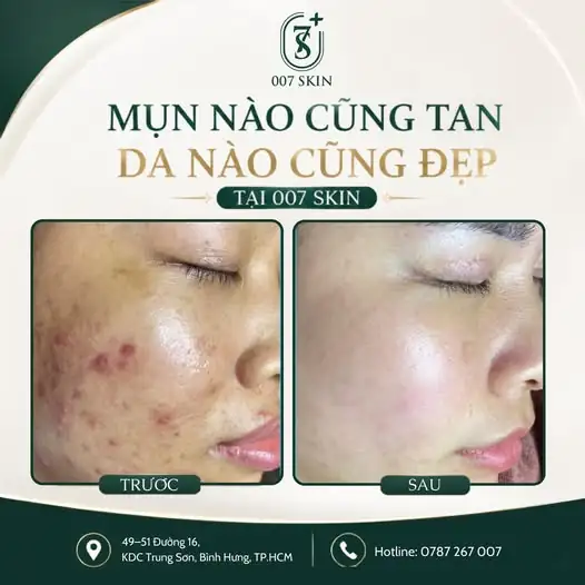 LÀN DA SẠCH MỤN – TỰ TIN HƠN MỖI NGÀY 🌿