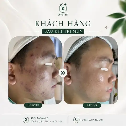 LÀN DA THAY ĐỔI – SỰ TỰ TIN TRỞ LẠI! ✨