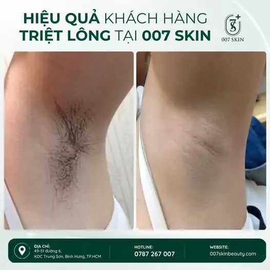 LỢI ÍCH KHI TRIỆT LÔNG NÁCH