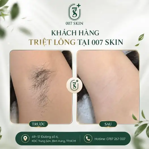 Lột bỏ nỗi lo về lông rậm – Tự tin với làn da mịn màng hơn mỗi ngày!