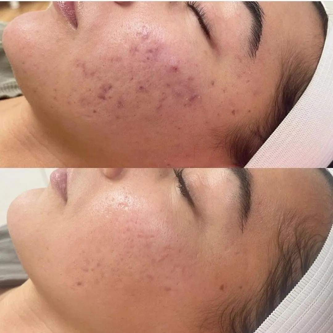 Meso: Dưỡng Ẩm Cho Da Lão Hóa - Giúp Da Căng Mọng, Giảm Nếp Nhăn, Ngăn Ngừa Lão Hóa Sớm.