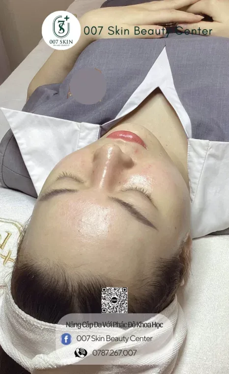 MESOTHERAPY DA SẠM KHÔNG ĐỀU MÀU