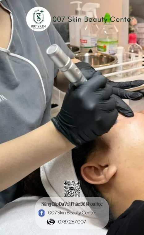 MICRONEEDLING PHI KIM CẢI THIỆN DA LÃO HOÁ, THÂM SẠM