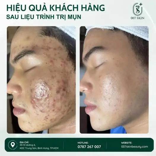 HIỆU QUẢ KHÁCH HÀNG SAU LIỆU TRÌNH TRỊ MỤN ✨