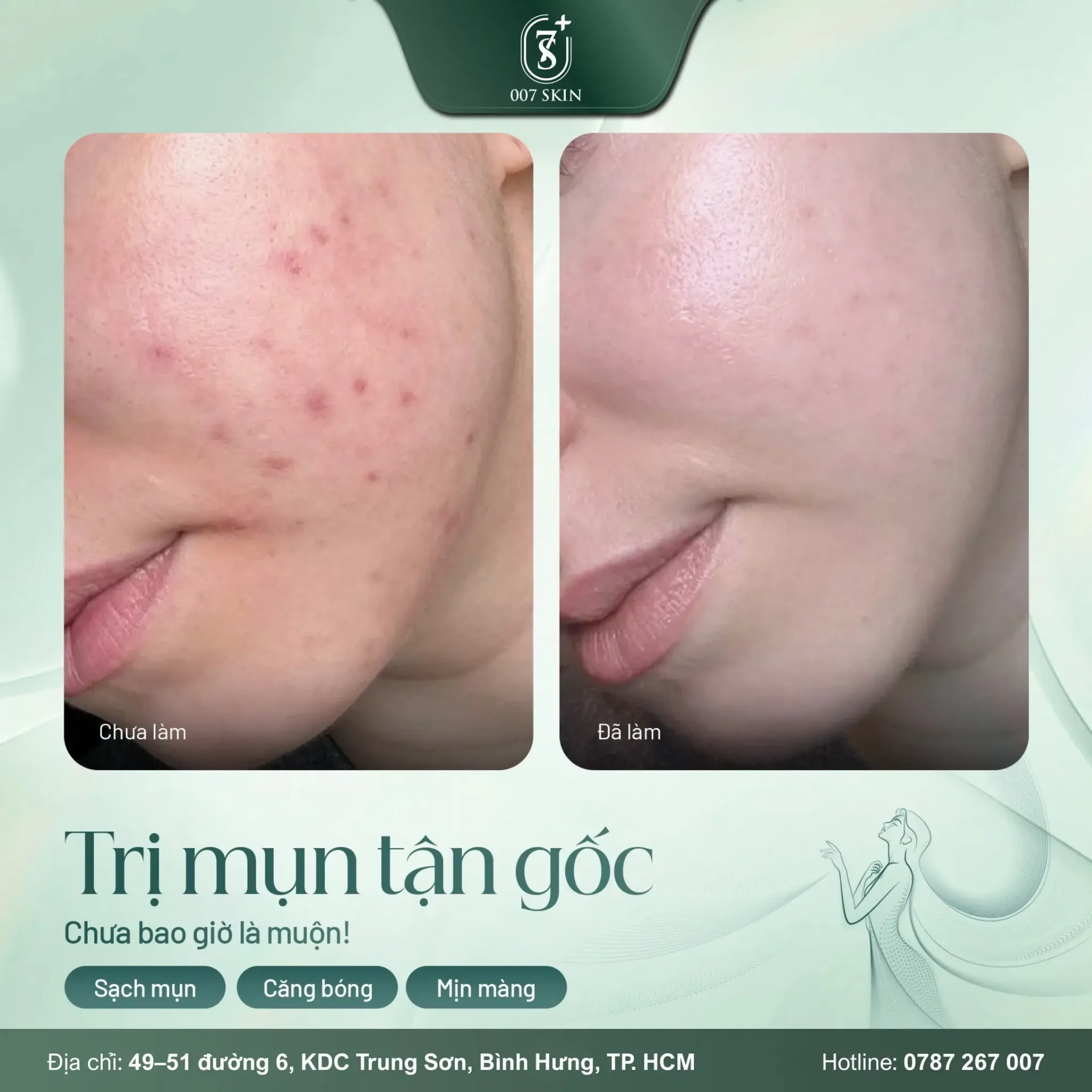 Một làn da sạch mụn – căng bóng – mịn màng không phải là điều xa vời, chỉ cần bạn chọn đúng nơi gửi gắm.