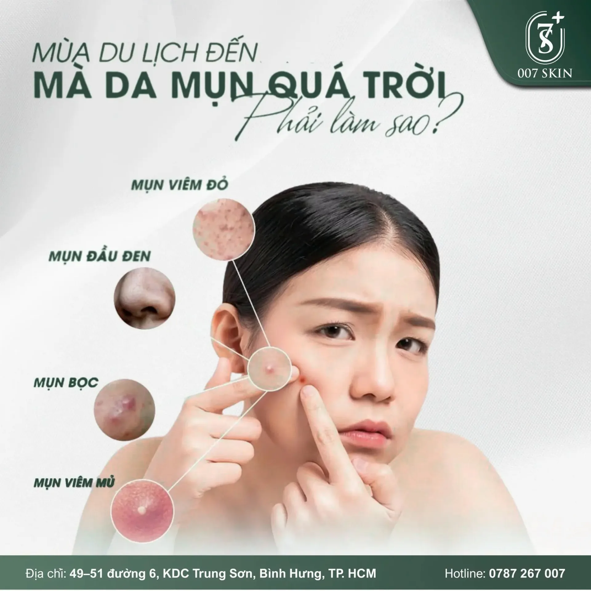 MÙA DU LỊCH ĐẾN NƠI – MỤN BỌC , MỤN VIÊM "TỚI CÔNG CHUYỆN" VỚI 007 SKIN!