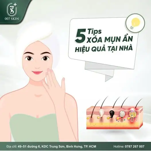 MỤN ẨN LÌ LỢM ĐẾN MẤY CŨNG PHẢI "CHÀO THUA"! ✨