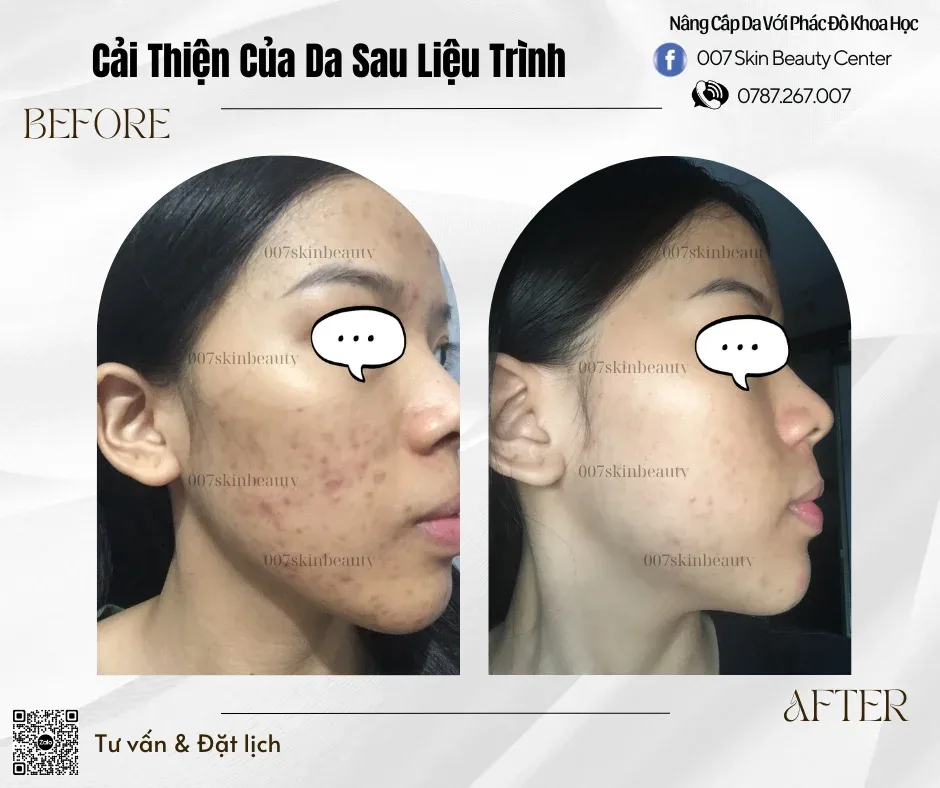 Mụn Là Gì? Giải Pháp Toàn Diện Cho Da Mụn & Lỗ Chân Lông Bít Tắc