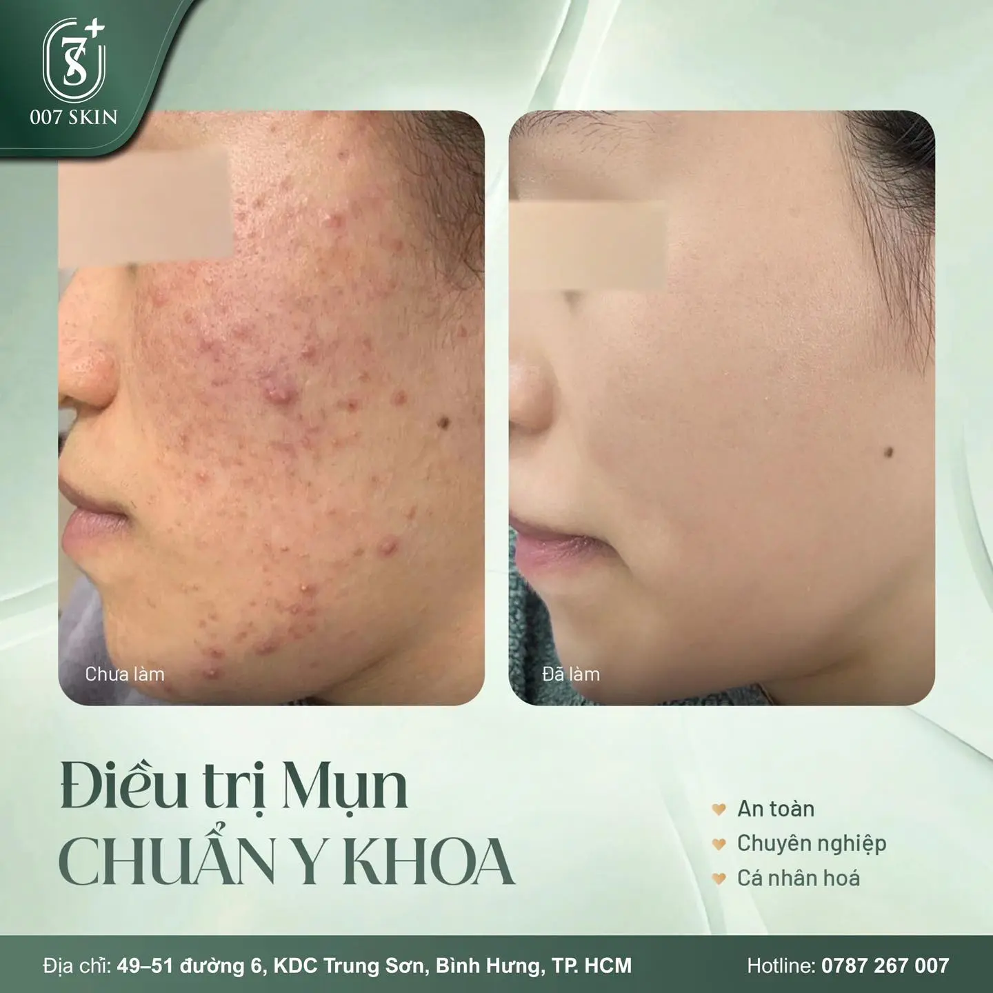 MỤN LÂU NĂM – DA ĐỎ VIÊM – SẸO THÂM CHAI LÌ?