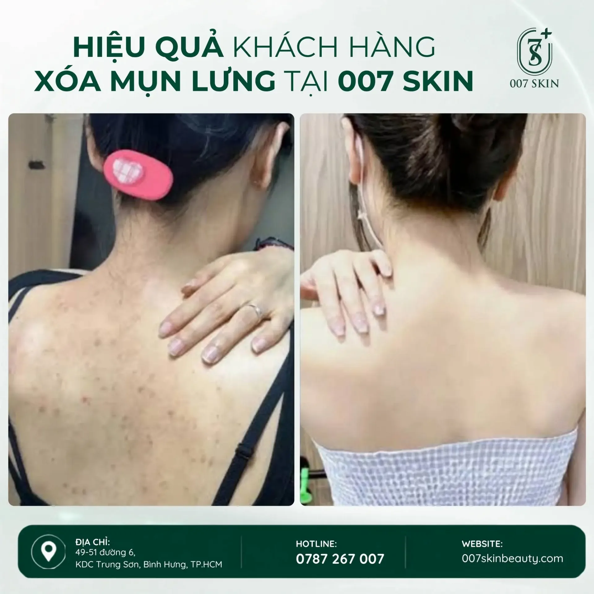 MỤN LƯNG – ĐỪNG ĐỂ LÀN DA KHIẾN BẠN NGẠI MẶC ĐẸP!