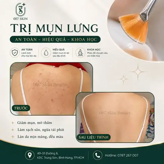 MỤN LƯNG KHÔNG CHỈ LÀ VẤN ĐỀ THẨM MỸ – MÀ CÒN LÀ DẤU HIỆU LÀN DA CẦN ĐƯỢC CHĂM SÓC ĐÚNG CÁCH!