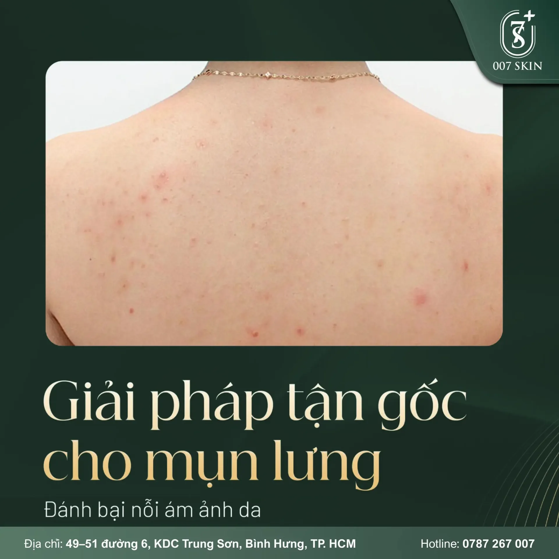 Mụn lưng – nỗi ám ảnh khiến bạn ngại diện đồ hở?