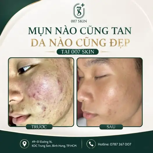MỤN NẶNG ĐẾN ĐÂU – CŨNG CÓ GIẢI PHÁP! ✨