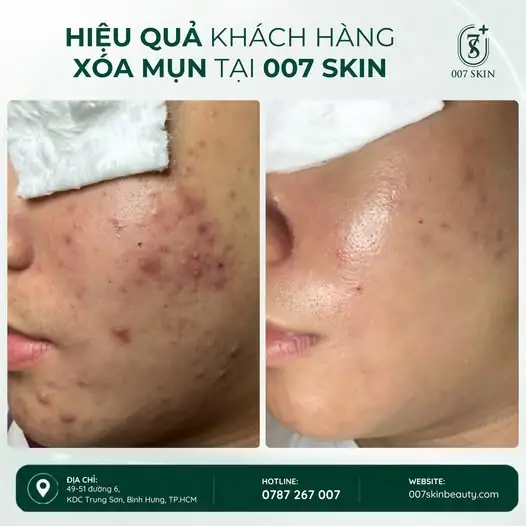 MỤN NHIỀU – DA SẦN – THÂM MỤN KHIẾN BẠN MẤT TỰ TIN?