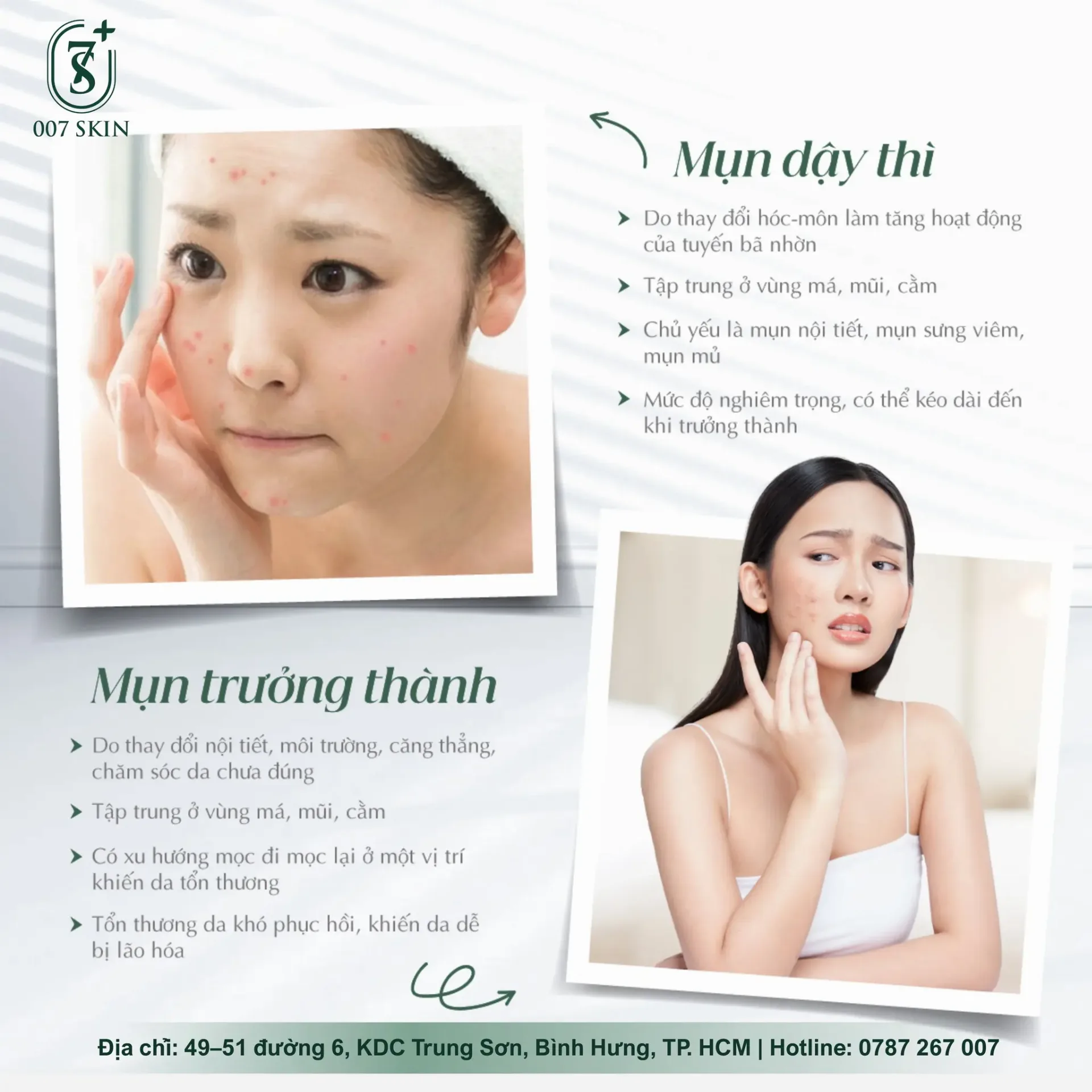 Mụn Tuổi Dậy Thì và Mụn Trưởng Thành: Nhận Biết, Điều Trị và Phòng Ngừa Hiệu Quả