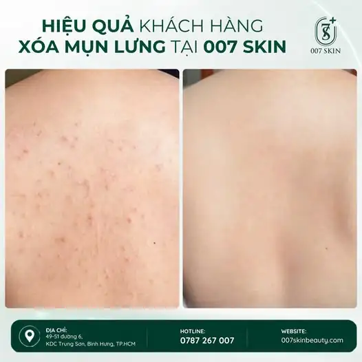 MUỐN DIỆN ĐỒ HỞ LƯNG NHƯNG LẠI NGẠI MỤN?