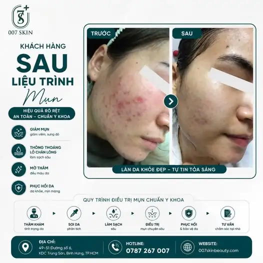 Muốn hết mụn, đừng chỉ trị mụn – hãy trị mụn ĐÚNG CÁCH! 🩺