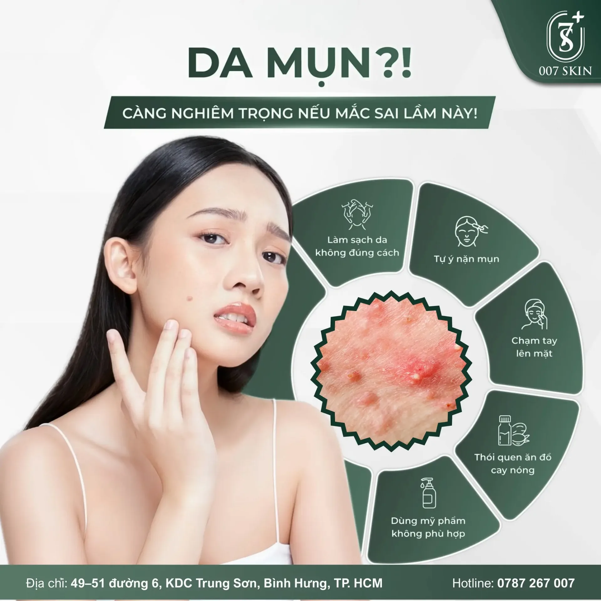 Ngừng ngay 5 thói quen nếu không muốn mụn “bùng nổ”