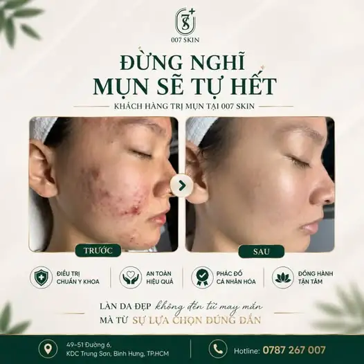 Nhiều bạn nghĩ rằng: "Cứ kệ mụn đi, tự nó sẽ lặn thôi!". Nhưng thực tế, mụn không "tự đi" mà còn để lại sẹo, vết thâm, và làm da yếu đi trông thấy đấy! 😔