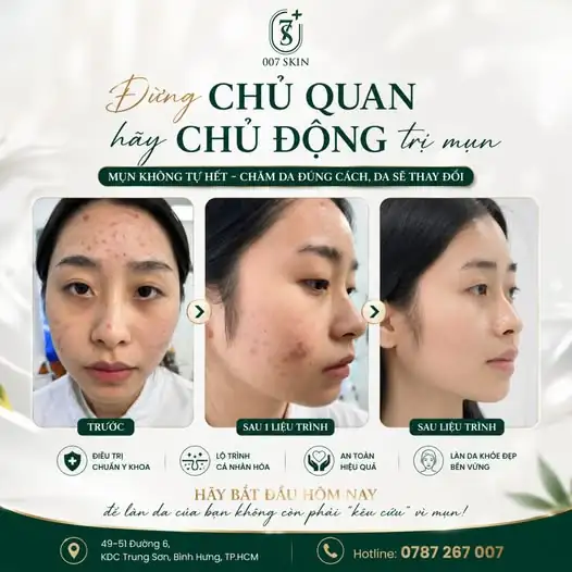 NHÌN LÀ THẤY NGAY SỰ KHÁC BIỆT! ĐỪNG CHỜ MỤN TỰ HẾT! 🌟