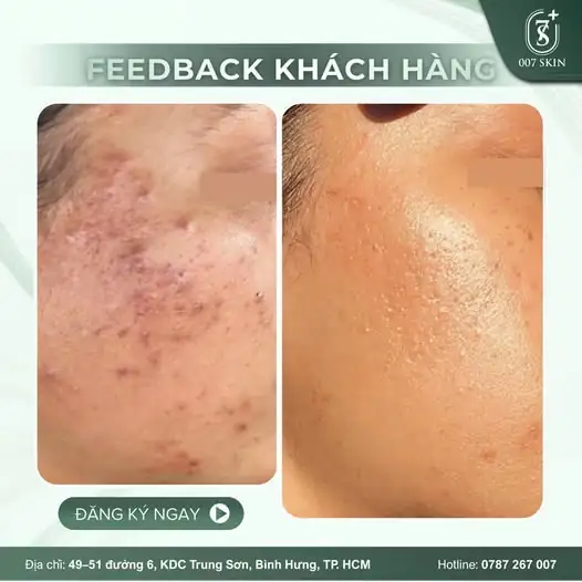 NHÌN LẠI HÀNH TRÌNH "CHIA TAY" MỤN VIÊM, MỤN ẨN LI TI CỦA KHÁCH YÊU: