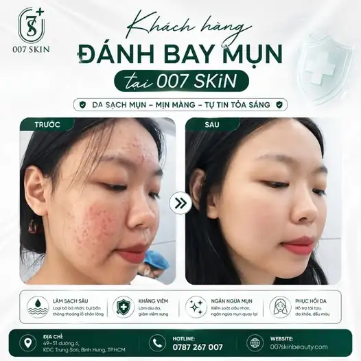 Nhìn làn da thay đổi "ngoạn mục" thế này mới thấy quyết định đến với 007 SKIN là hoàn toàn đúng đắn. Từ hàng loạt nốt mụn viêm, thâm sạm và dầu nhờn, làn da của vị khách nhà 007 SKIN đã tái sinh khỏe mạnh, mịn màng không tì vết.