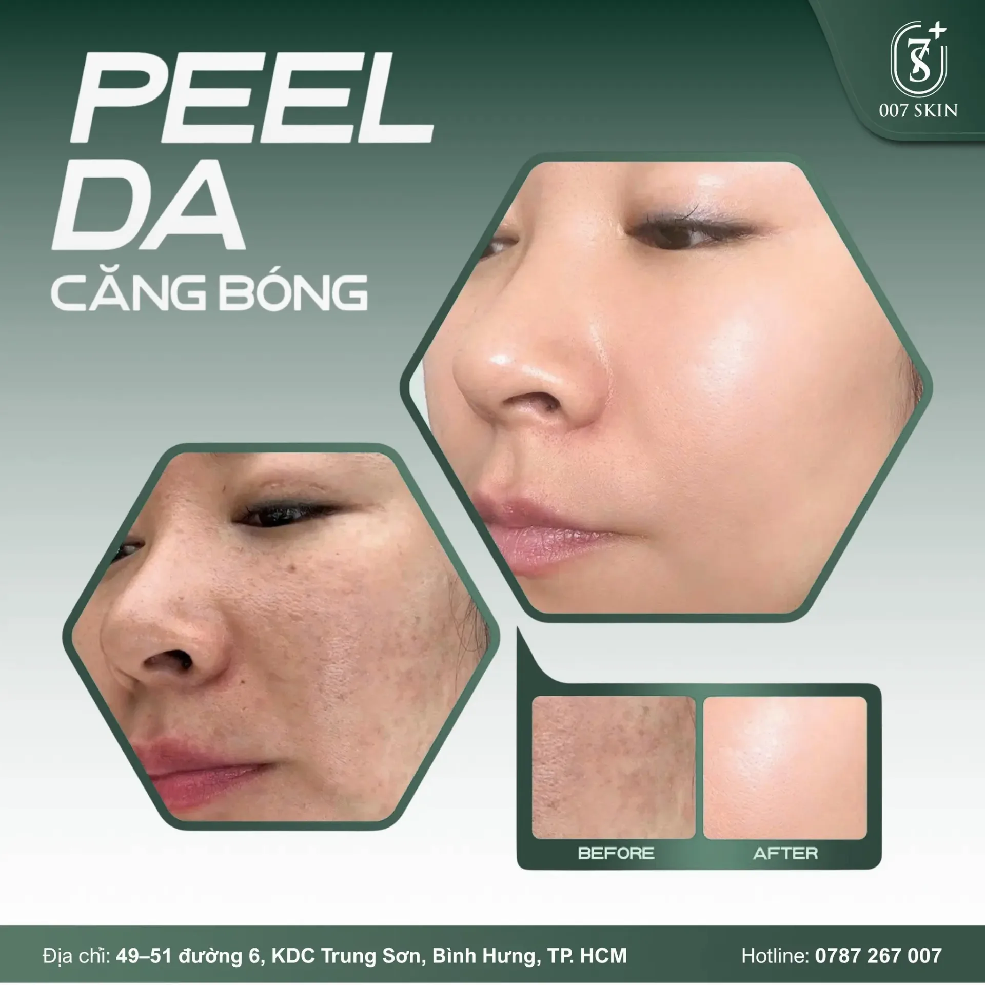 PEEL DA CĂNG BÓNG – DA MỊN SÁNG THẤY RÕ SAU LIỆU TRÌNH