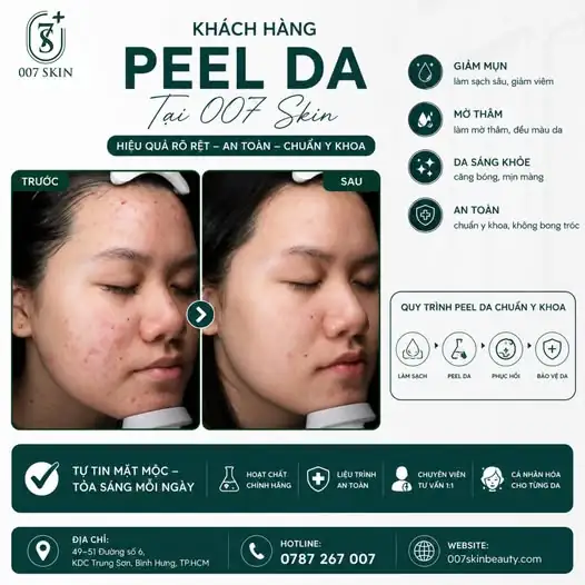 PEEL DA CHUẨN Y KHOA – GIẢI PHÁP VÀNG CHO LÀN DA KHOẺ ĐẸP 💯
