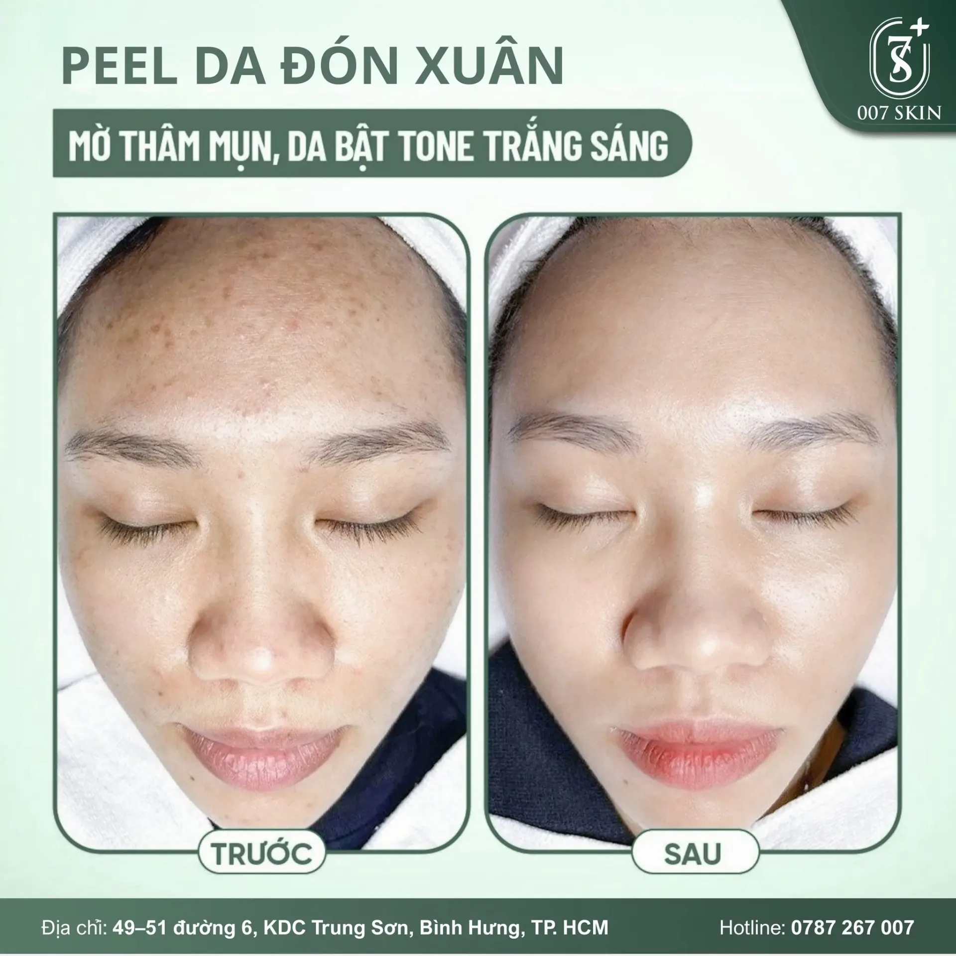 PEEL DA ĐÓN XUÂN – BẬT TONE SÁNG MỊN, MỜ THÂM MỤN