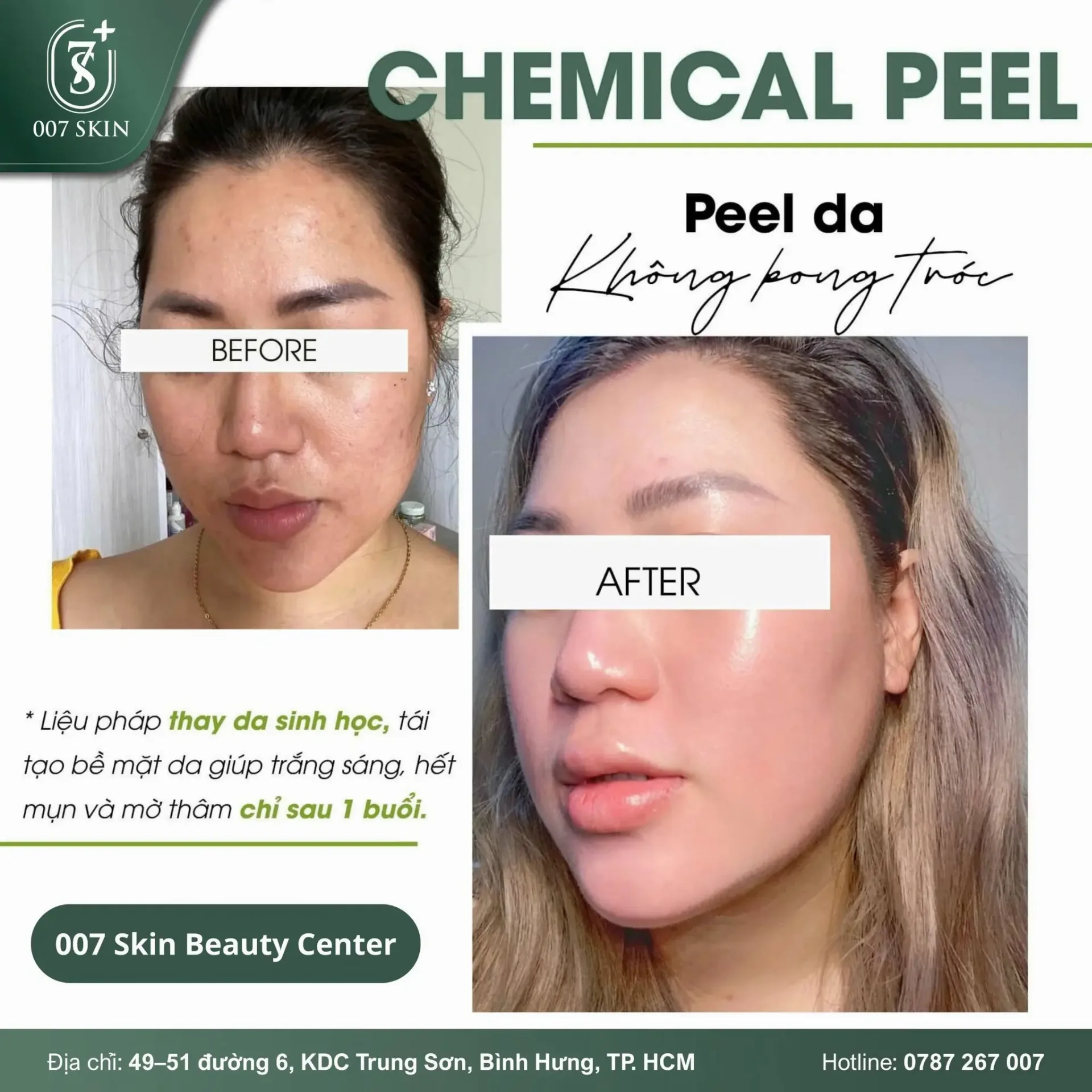 PEEL DA KHÔNG BONG TRÓC – BẬT TONE SAU 1 BUỔI