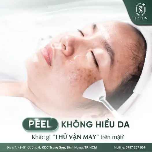 PEEL DA KHÔNG ĐÚNG CÁCH – KHÁC GÌ "THỬ VẬN MAY" TRÊN CHÍNH KHUÔN MẶT? 😱