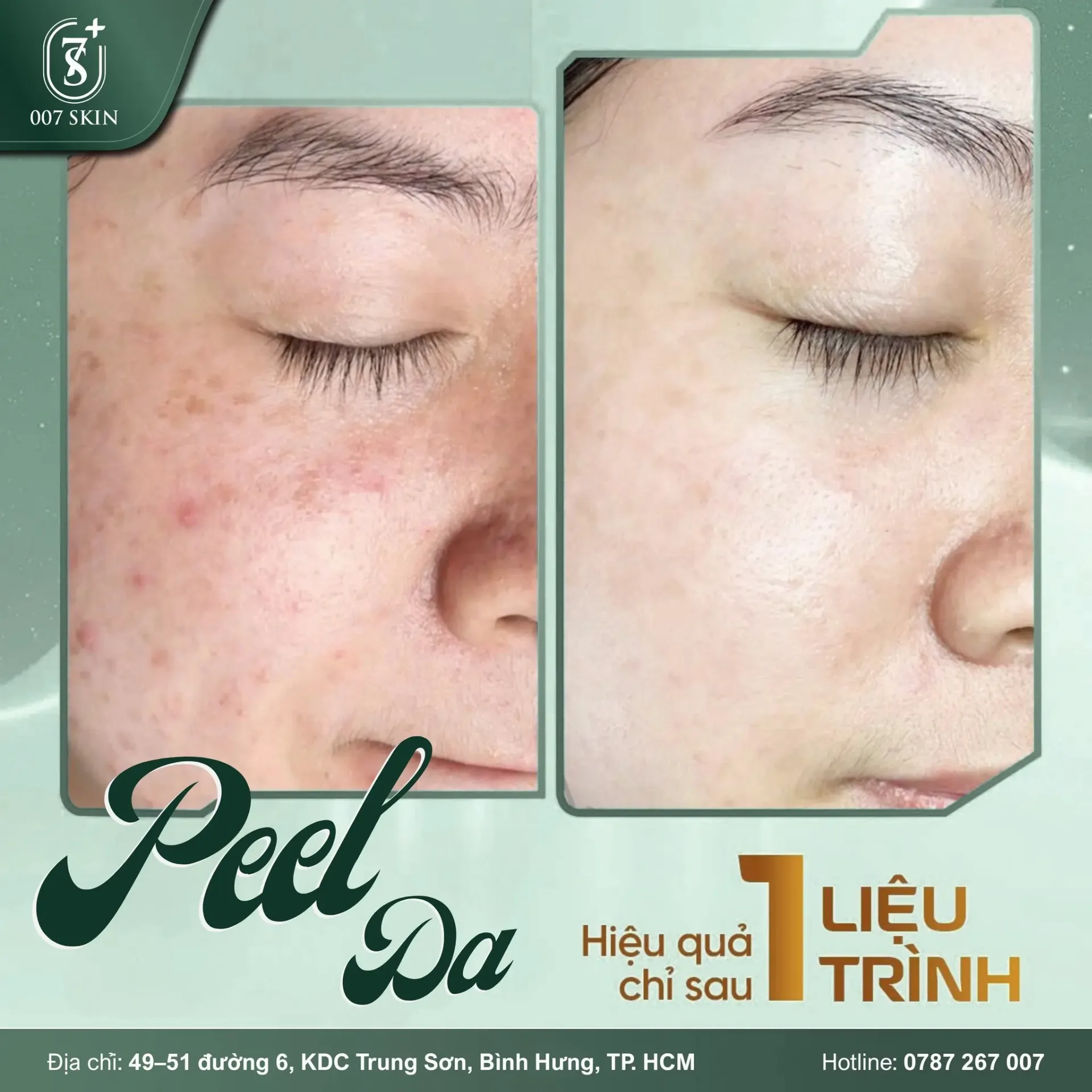 PEEL DA – LÀN DA THAY ĐỔI CHỈ SAU 1 LIỆU TRÌNH