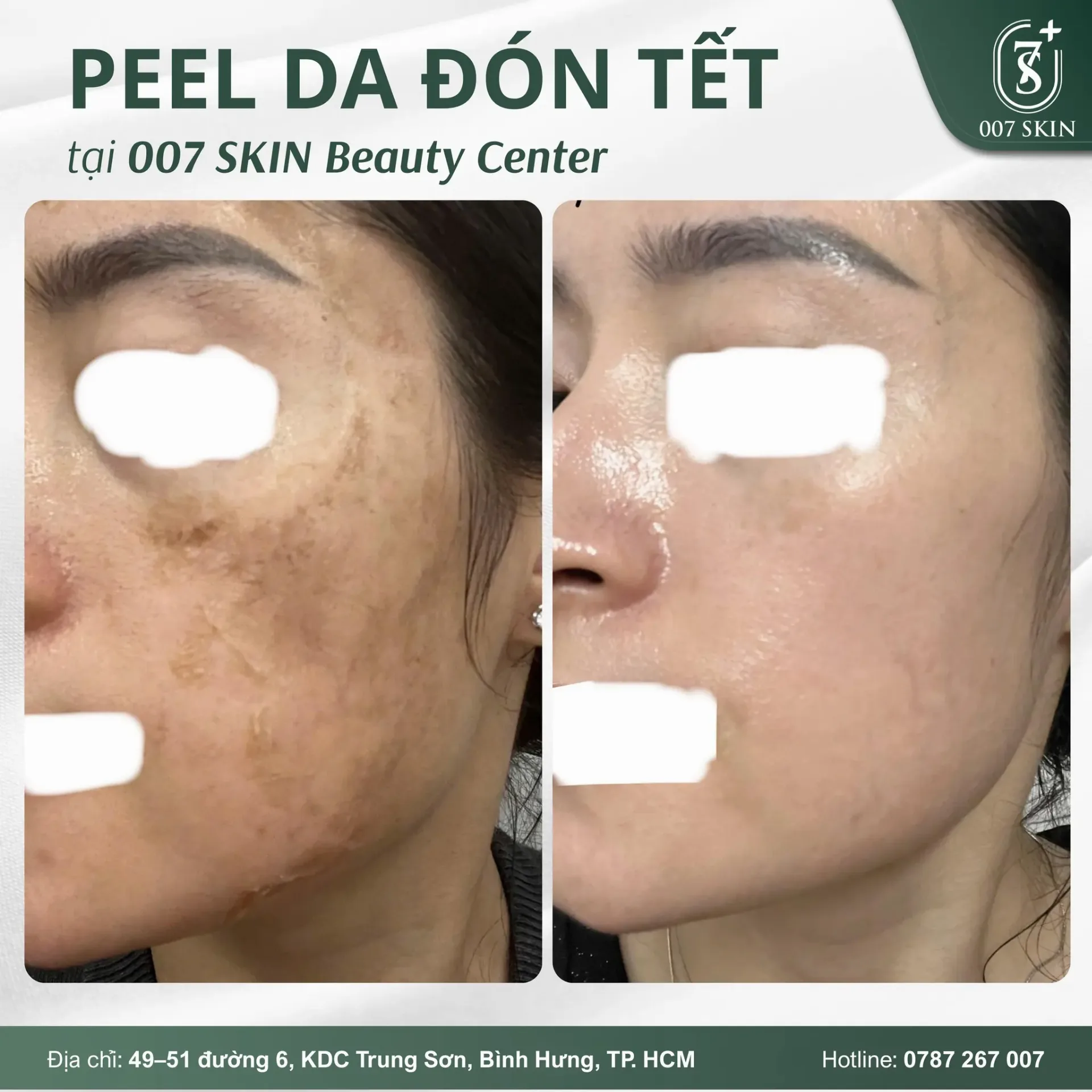 PEEL DA MỜ NÁM – ĐỀU MÀU DA ĐÓN TẾT 🌸