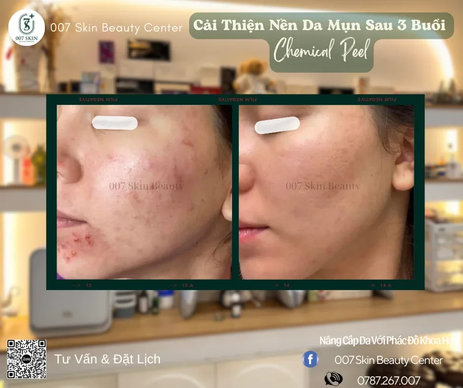 Review Chân Thực: Peel Da + Nặn Mụn - Khách Hàng Nói Gì?