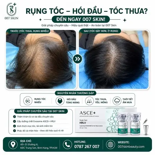 RỤNG TÓC - HÓI ĐẦU - TÓC THƯA: NỖI ÁM ẢNH KHÔNG CỦA RIÊNG AI!