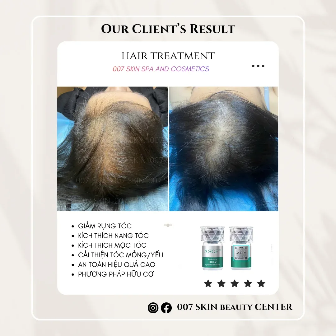RỤNG TÓC – HÓI ĐẦU – TÓC THƯA?
