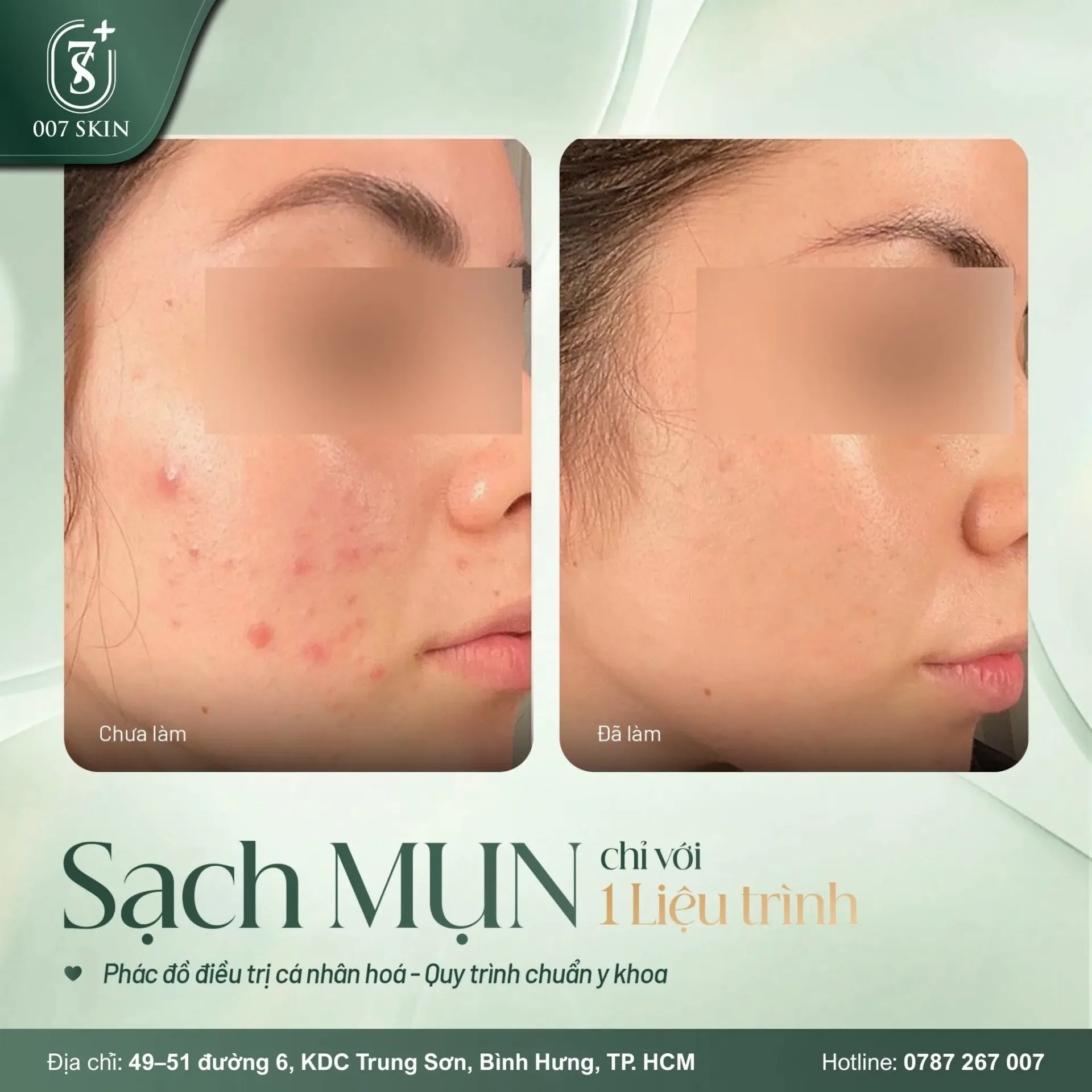SẠCH MỤN RÕ RỆT – CHỈ SAU 1 LIỆU TRÌNH