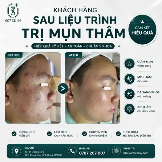 SẠCH MỤN THÂM CHỈ SAU 1 LIỆU TRÌNH 🛡️