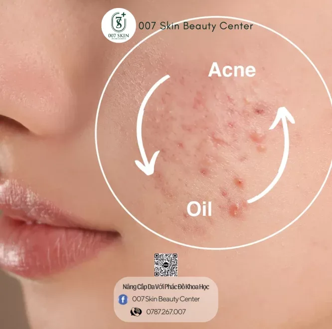 Sai Lầm Phổ Biến Khi Skincare Gây Mụn Và Khiến Da Ngày Càng Nhạy Cảm