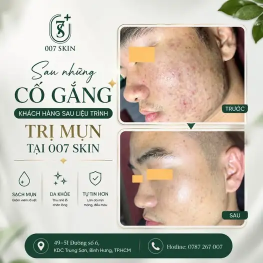 Sau những ngày kiên trì – thành quả là một làn da đáng tự hào! ✨