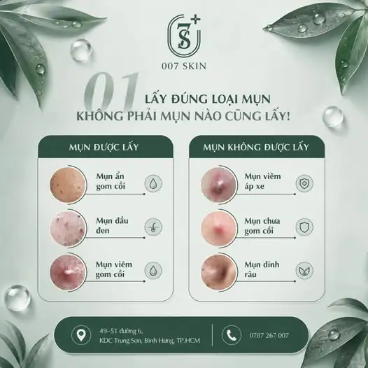 SỰ THẬT VỀ LẤY MỤN: KHÔNG PHẢI MỤN NÀO CŨNG NÊN ĐỤNG VÀO! 🛑
