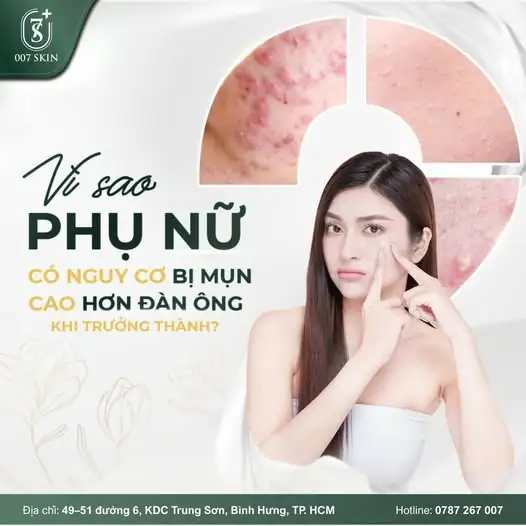 TẠI SAO PHỤ NỮ DỄ BỊ MỤN HƠN ĐÀN ÔNG KHI TRƯỞNG THÀNH? ✨