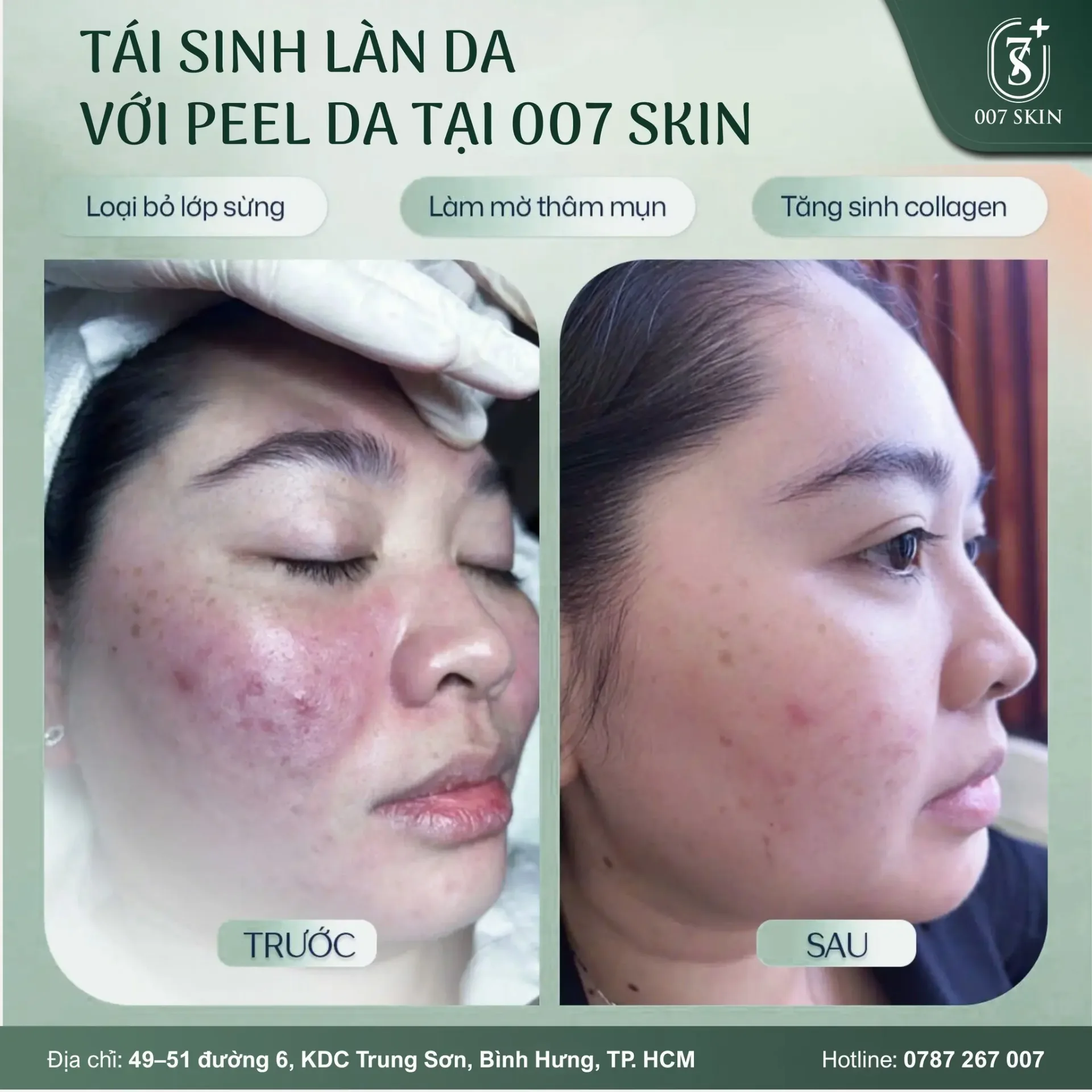TÁI SINH LÀN DA – LỘT XÁC SAU PEEL DA TẠI 007 SKIN ✨