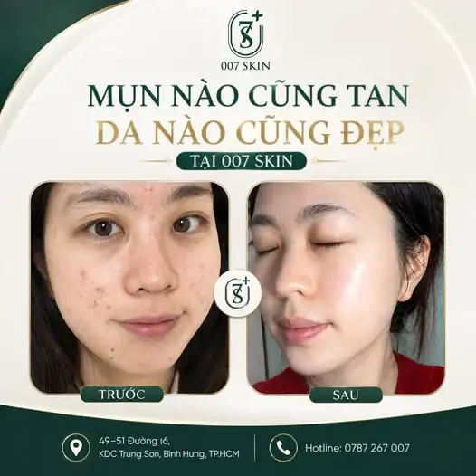 Tạm biệt mụn – Chào làn da khỏe đẹp, tự tin hơn mỗi ngày!