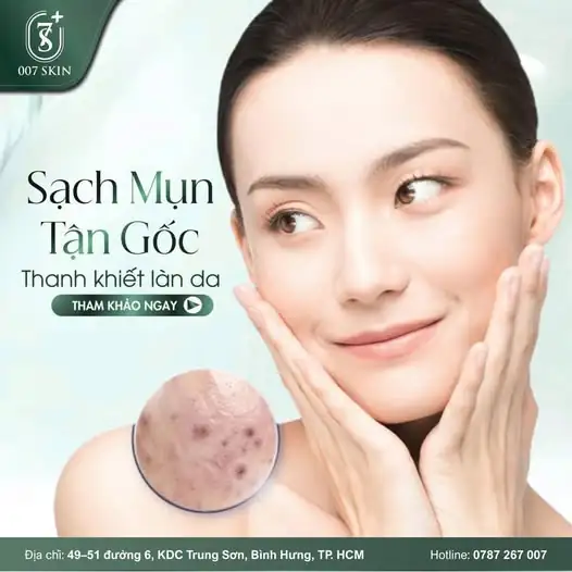 TẠM BIỆT MỤN – ĐÓN DIỆN MẠO RẠNG RỠ CÙNG 007 SKIN! ✨