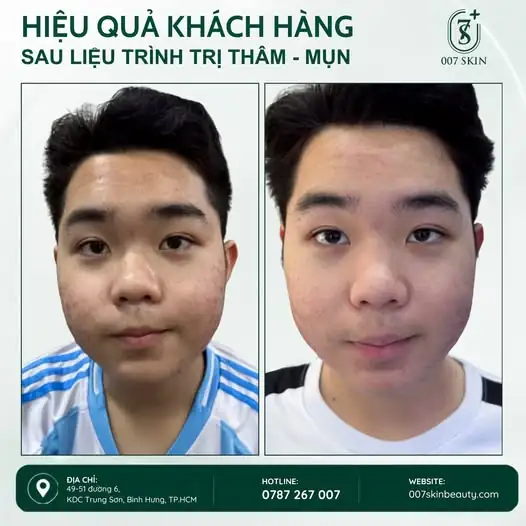 Tạm biệt mụn – lấy lại làn da tự tin 💚