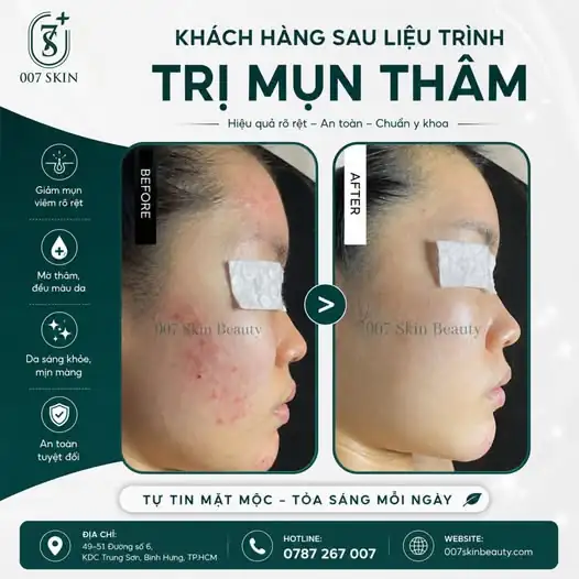 TẠM BIỆT MỤN THÂM – TỰ TIN KHOE MẶT MỘC ✨