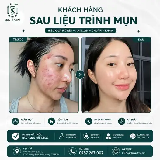 Tạm biệt mụn, tự tin khoe mặt mộc chỉ sau một liệu trình! ✨
